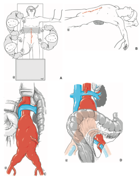 Chirurgie Vasculaire POLYCLINIQUE BEZANNES anévrysmes aorte